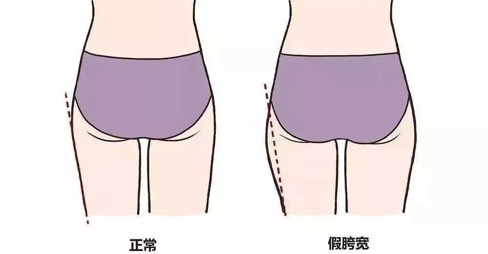 真假胯宽怎么区分？假跨宽有什么危害？如何改善？