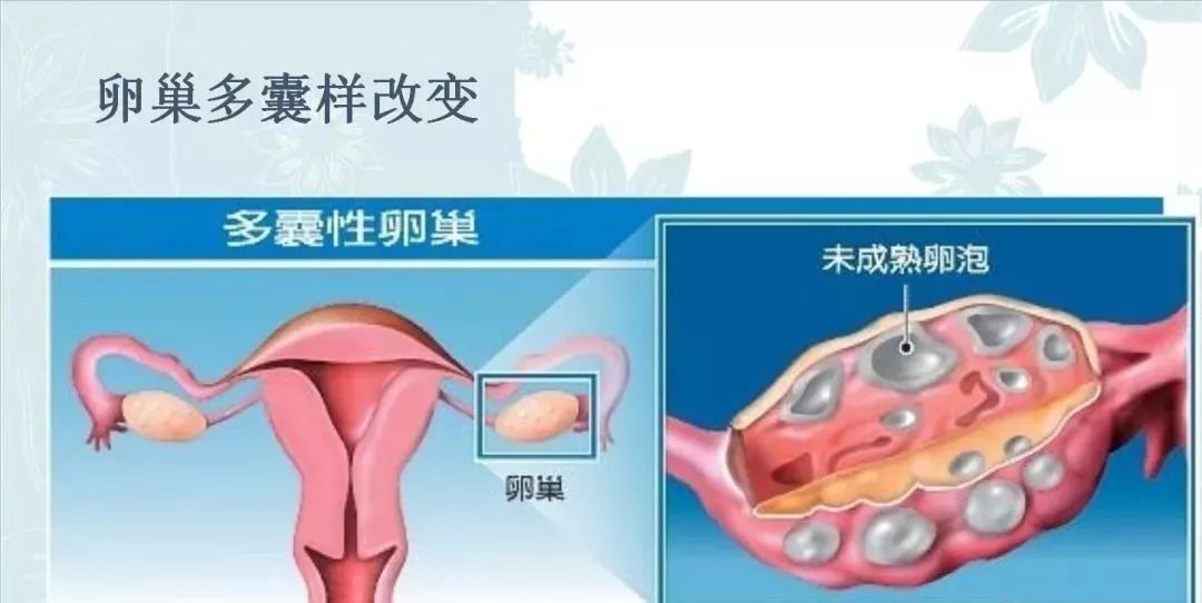 瘦多囊有哪些症状？出现瘦多囊应该怎么治疗？