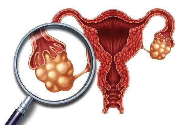 出现多囊卵巢原因是什么？怎么治疗多囊卵巢？