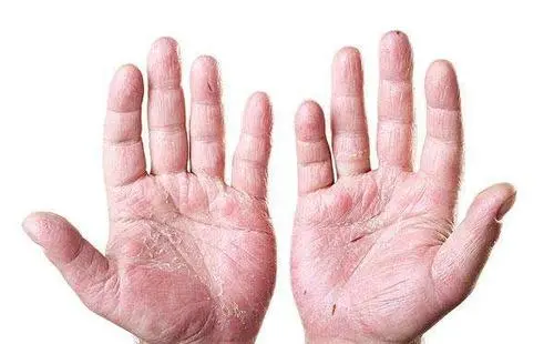 手老是脱皮怎么办？有什么好的方法可以解决手部脱皮问题？