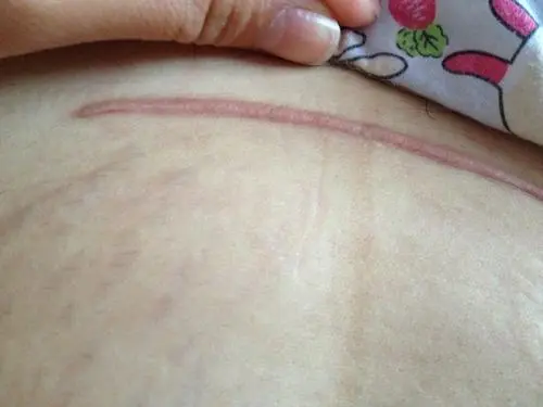 孕妇怀三胎后多少周要做疤痕检测?疤痕厚度1.8mm可以顺产吗?