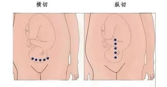 做完剖腹产手术需要注意什么呢?剖腹产后几小时翻个身?