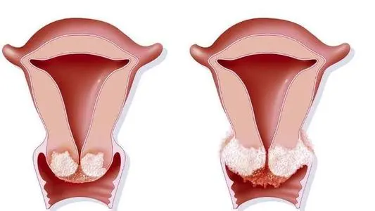 宫颈糜烂到底会有哪些症状?如何治疗宫颈糜烂和宫颈炎呢?