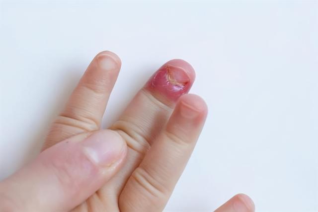 婴儿如果有甲沟炎怎么拔指甲？疼不疼？