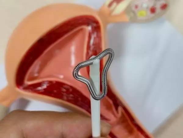 上环后需要卧床休养吗？会导致其他疾病吗？